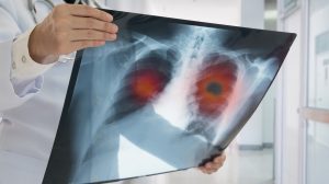 Lung cancer drug Keytruda to become routinely available on NHS