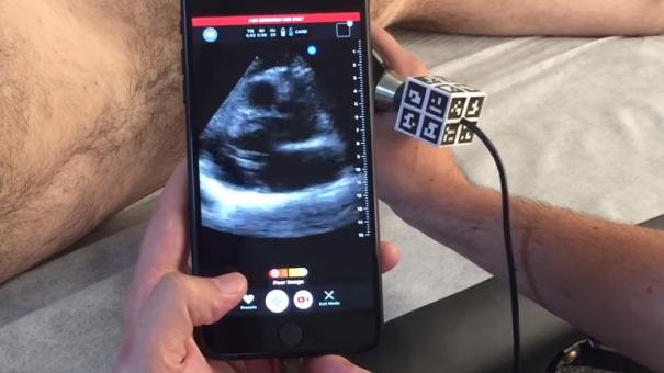 Butterfly Network’s smartphone ultrasound device launches in UK