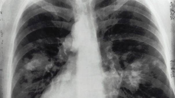 X_ray_chest
