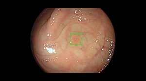 AI device cleared by FDA to spot lesions during colonoscopy