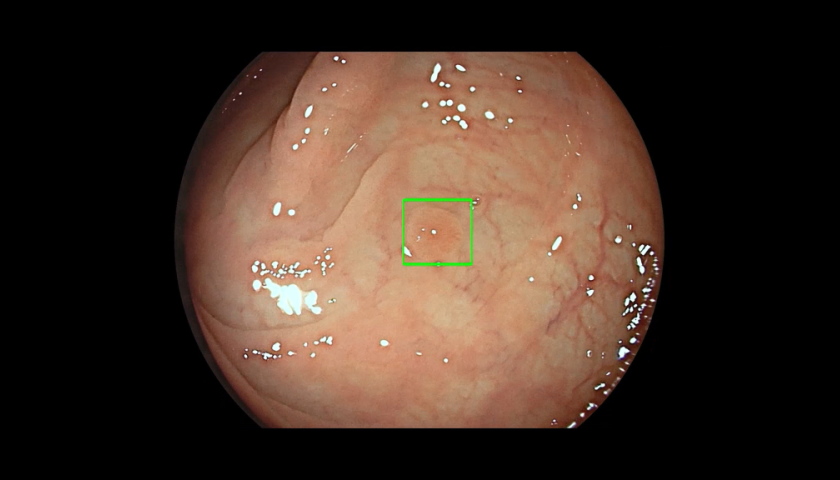 Medtronic_GI_Genius_intelligent_endoscopy_module