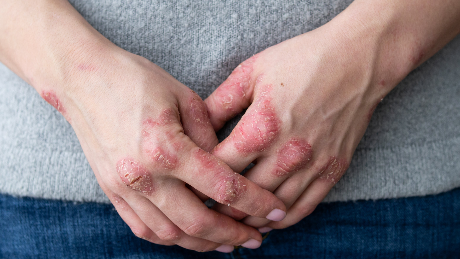 Psoriatic hands crossed over each other