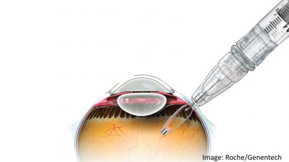 FDA clears Roche's Susvimo implant for eye disease wet AMD