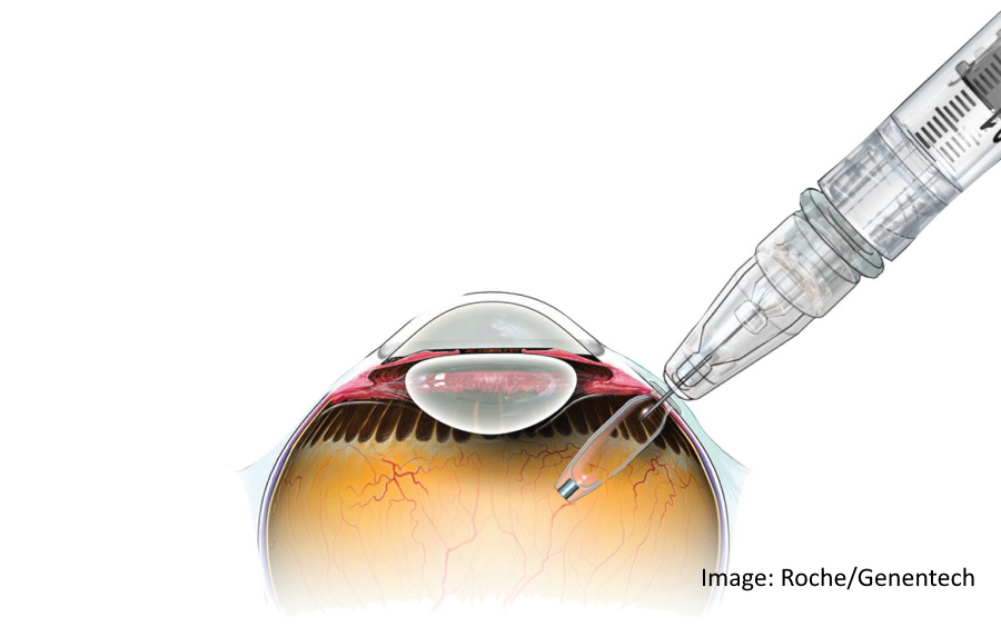 Roche_Susvimo_AMD