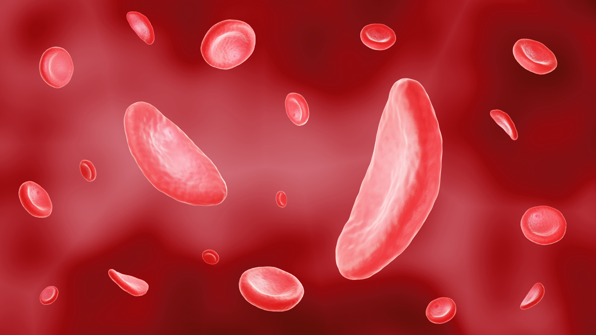 sickle cell