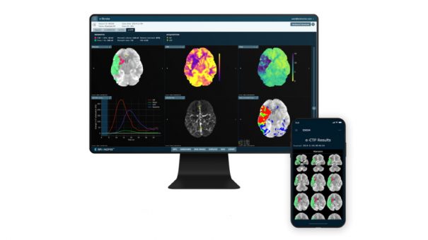 Boehringer invests again in AI diagnosis specialist Brainomix