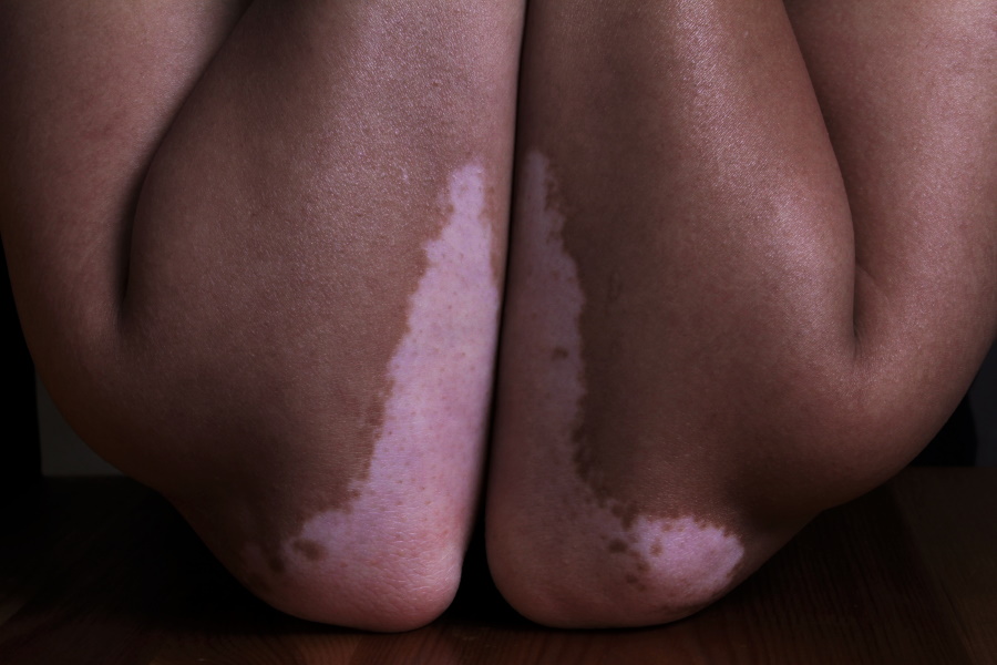 vitiligo_via_unsplash