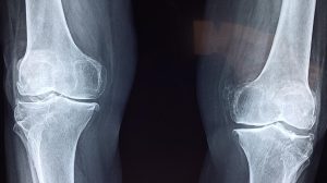 knee_x_ray