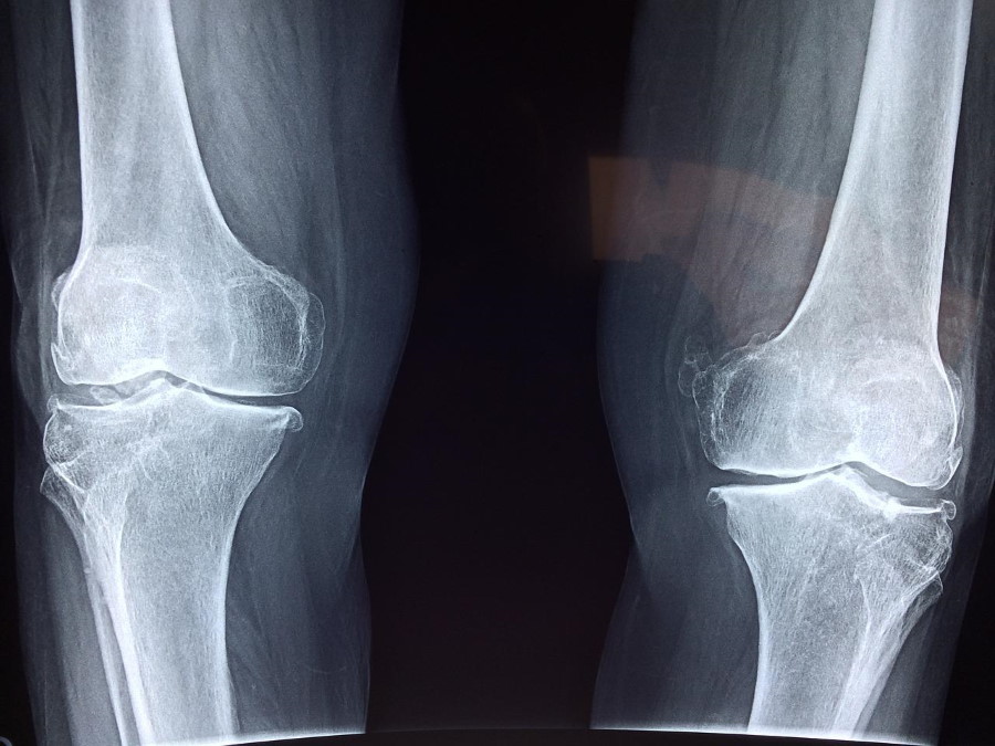 knee_x_ray