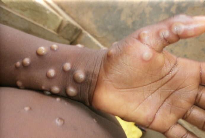 Monkeypox_image_WHO