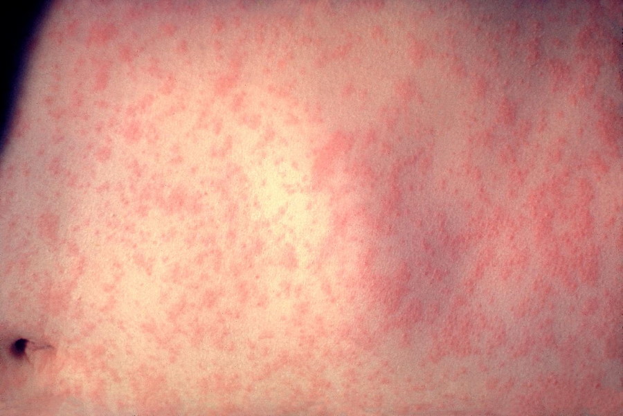 measles_rash