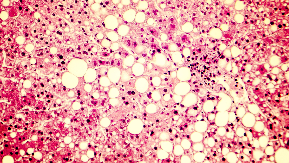 Fatty liver, liver steatosis. Photomicrograph showing large vacuoles of triglyceride fat accumulated inside liver cells, it occurs in alcohol overuse, under action of toxins, in diabetes